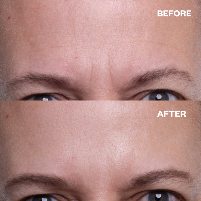 Forehead Wrinkle Patches - 2 Patches | Wrinkles Schminkles